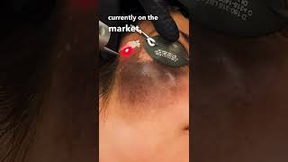 THIS Laser Can Erase Birthmarks Birthmark TreatmentHyperpigmentation laserskincare [upl. by Revell]