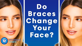 Do Braces Change Your Face  The Impact Of Braces On Your Jawline amp Face Shape [upl. by Nace280]