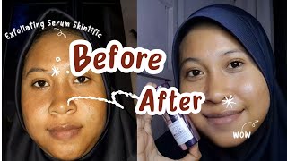 HASIL SETELAH EXFOLIASI PAKE SERUM LACTIC ACID SKINTIFIC [upl. by Richlad]