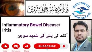 Inflammatory Bowel DiseaseIritisAnkh ki putli ki Soojan [upl. by Atil]