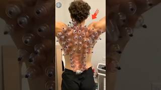 Cupping therapy explained 🫥 [upl. by Rebmyt]