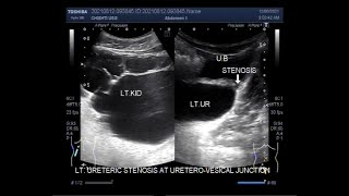 Ureterovesical junction UVJ obstruction causing Hydronephrosis and Hydroureter [upl. by Eelrihs982]