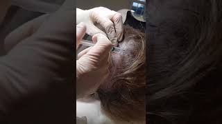 MicronJet™ in Action Intradermal Delivery of PRP to the Scalp Area Dr Elisabeth Dancey [upl. by Aileme]