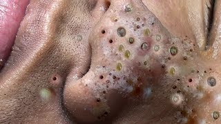 acne blackheads whiteheads removalcystic acne blackhead whitehead removalbig cystic acneext12084 [upl. by Alon443]