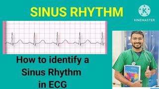 Sinus RhythmsECGHow to interpretation of a Sinus Rhythm in ECG [upl. by Wiltshire]