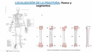 Clasificación de las Fracturas [upl. by Karoly]