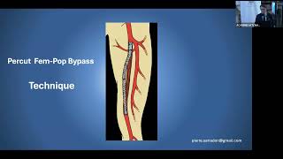 04 Nouveau concept en chirurgie vasculaire  le Pontage Percutané applications et perspectives [upl. by Ettennal338]