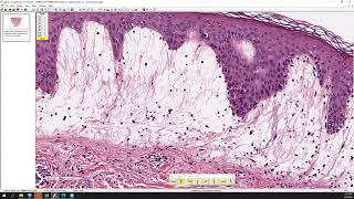 Polymorphous light eruption PMLE [upl. by Remot]