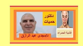 الذئبة الحمراء وأحدث طرق علاجها SYSTEMIC LUPUS ERYTHEMATOSUS [upl. by Ailemap]