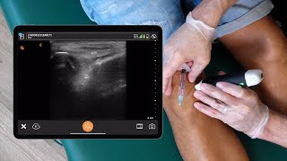 Ultrasound Informed Parapatellar Injection [upl. by Atirhs345]