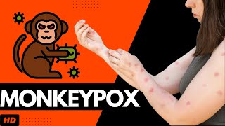 Monkeypox Everything You Need To Know [upl. by Ellenahs951]