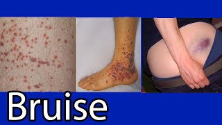 Bruise Hematoma blue spots on skin causes and treatment [upl. by Asseral218]