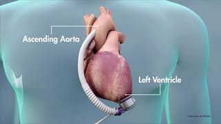 Treating Heart Failure with the Heartmate 3 LVAD [upl. by Akiehs]