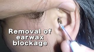 Dry Earwax Blockage Removal [upl. by Dash558]