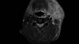 Masticator space abscess A Ahuja AT et al 2017 Book Essential Radiology [upl. by Enois]