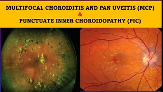 Multifocal choroiditis and Punctate inner choroidopathy [upl. by Travus298]