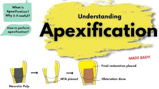 Apexification  What is it  Endodontics [upl. by Norred]