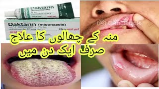 daktarin oral gel how to use miconazole gel oral thrush treatment [upl. by Irrab]