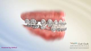 Upper 5 Lower 4 Extraction  Underbite  Orthodontic Treatment [upl. by Hudnut]