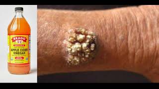 WART REMOVAL APPLE CIDER VINEGAR The 2 Methods That Have Ever Actually Worked For Me [upl. by Weisbrodt750]