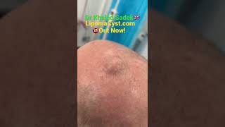 Massive Pilar cyst removal with Dr Khaled Sadek LIPOMACYST [upl. by Biel]