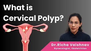 What is Cervical Polyp  Causes and Treatment  DrRicha Vaishnav [upl. by Rediah515]