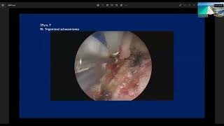 Endoscopic Kayhole Anterior Petrosal Approach to Petrous Lesions  Professor Takeo Goto [upl. by Yesoj]