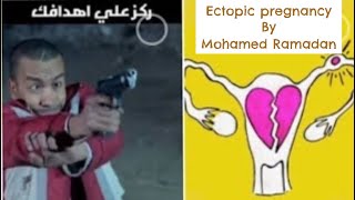 13 ectopic pregnancy by dr M Ramadan [upl. by Veriee]