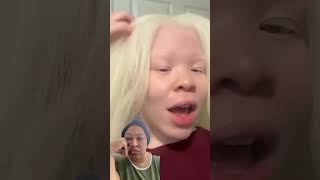 Living with Albinism Navigating Life and Love as Identical Twinspamsperspective trulychannel [upl. by Adnuhsor]