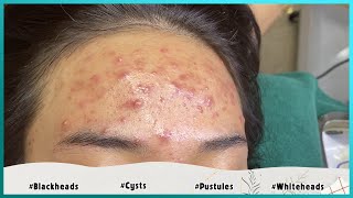 Big Cystic Acne Blackheads Extraction Blackheads amp Milia Whiteheads Removal Pimple Popping [upl. by Onaicilef352]