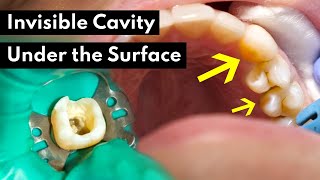 How Dentists Treat INVISIBLE CAVITIES [upl. by Delfine]