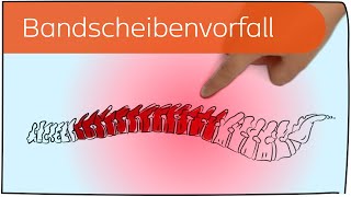 Bandscheibenvorfall in 3 Minuten erklärt [upl. by Shirleen]