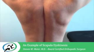 Scapula Dyskinesis  Treatment by Los Angeles Orthopedic Surgeon Dr Steven Meier [upl. by Yssis]