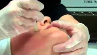 Dermapen Micro Needling Treatment [upl. by Pascasia]