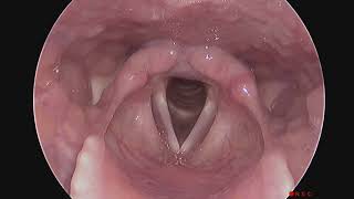 Normal Larynx Endoscopy Without Sound and No Stroboscopy [upl. by Othello]