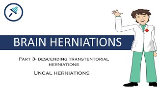 BRAIN HERNIATIONS 34  Uncal herniation [upl. by Eiramlatsyrk]