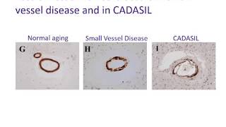 002 Small vessel disease amp CADASIL [upl. by Aerdnu]