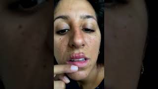 Cystic acne and blackheads removal  Newest pimple pops for 2022 [upl. by Verdha317]