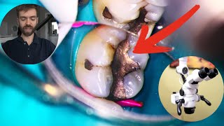 The SAFE WAY to remove Silver Mercury Fillings Amalgam [upl. by Lahsram615]