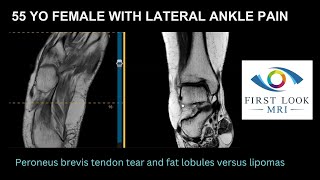 Peroneus brevis tendon tear and fatty lobules in foot [upl. by Rebmyt]