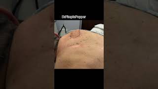 A Perfect Lipoma Technique [upl. by Odlamur]