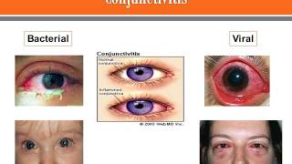 Conjunctivitis [upl. by Hike930]