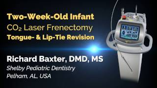 Infant CO2 Laser Frenectomy  Tongue amp LipTie Release  Richard Baxter DMD [upl. by Aiht]