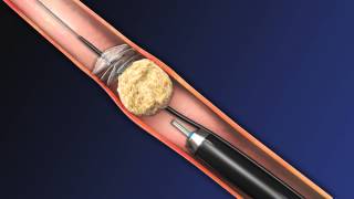 CoAx 10mm Stone Control Catheter from Accordion Medical [upl. by Chung]