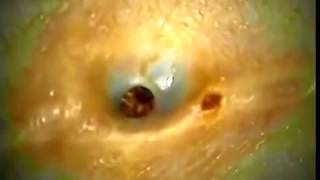 The most AMAZING Dilated Pore Of Winer [upl. by Mcarthur]