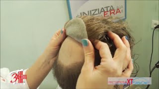 IMPIANTO CAPELLI UOMO 3T IONIX  Sicurmed [upl. by Dayiz]