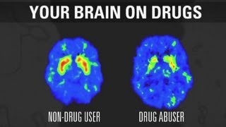 How addiction changes your brain [upl. by Enilorac]