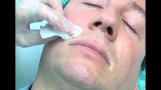 Surcos Nasogenianos  Tratamiento Facial [upl. by Maxim]