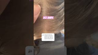 Lice jumps l lice removal service explore hairtok hair lice [upl. by Clite]