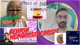 NEPHROSCLEROSISEFFECT OF HYPERTENSION ON KIDNEY PART 21  NEPHROLOGY [upl. by Dazhehs]